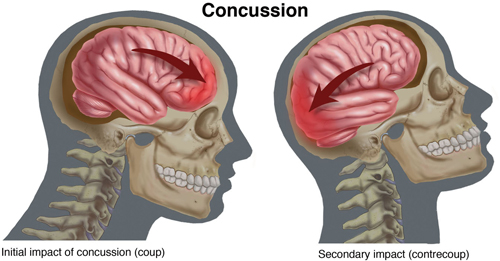 Concussion Recovery in Baltimore: Concussions Explained Concussion Recovery in Baltimore: Concussions Explained